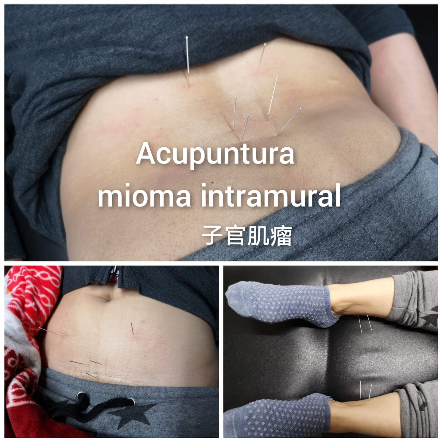 子宫肌瘤4.jpg